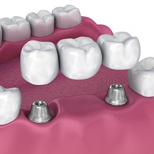 Digital image of an implant bridge