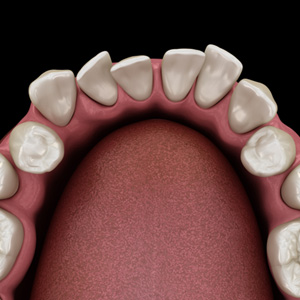 Illustration looking down at a lower arch with overlapping enamel