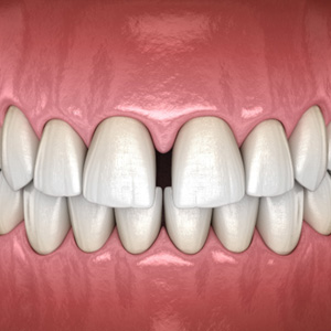 Illustration of a diastema in front teeth with black background
