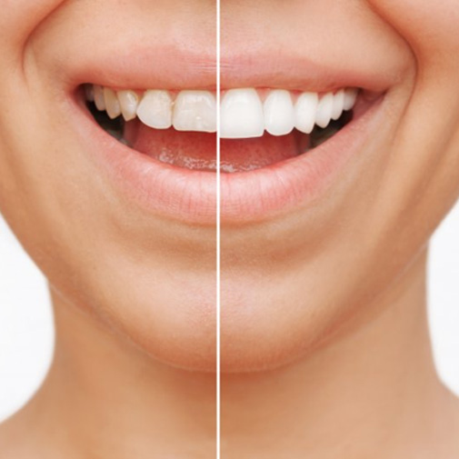 Before and after veneers