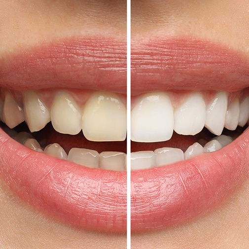Closeup of a smile that’s half-whitened to show before/after treatment results