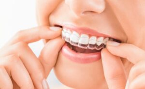 Woman fitting Invisalign aligner onto top teeth. 